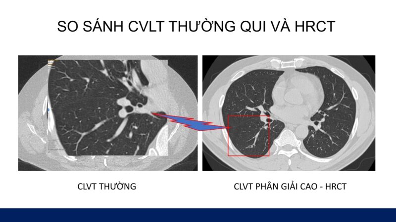 Tiếp cận ban đầu HRCT và các kiểu hình tổn thương UIP, có thể UIP trên HRCT