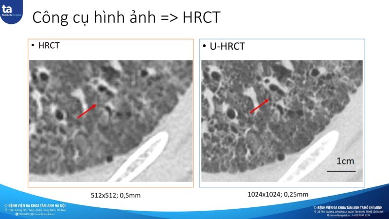 Viêm phổi kẽ không đặc hiệu (NSIP) và quy trình đánh giá xơ phổi tiến triển (PPF) trên HRCT