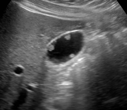 Case Polyp túi mật