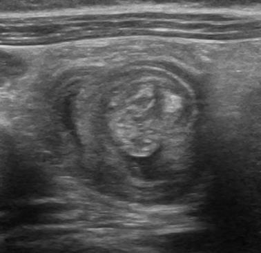 Case lồng ruột