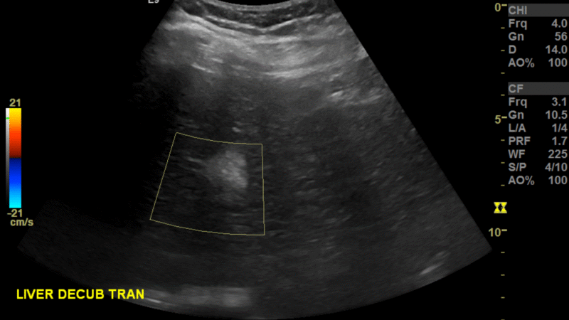 Steatohepatitic hepatocellular carcinoma (SH-HCC)