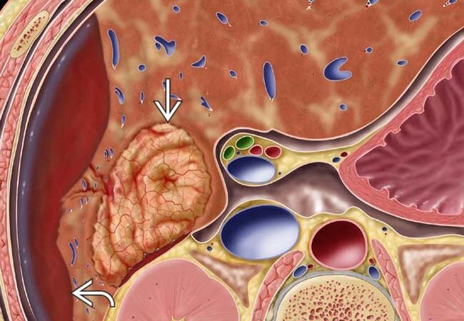 U tuyến tế bào gan (Hepatic Adenoma)