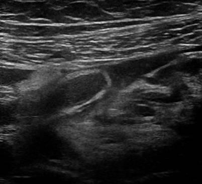 Case lâm sàng viêm ruột thừa cấp